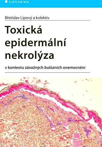 Toxická epidermální nekrolýza v kontextu závažných bulózních onemocnění